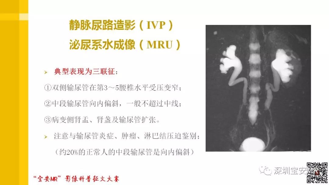 【PPT】腹膜后纤维化的影像诊断