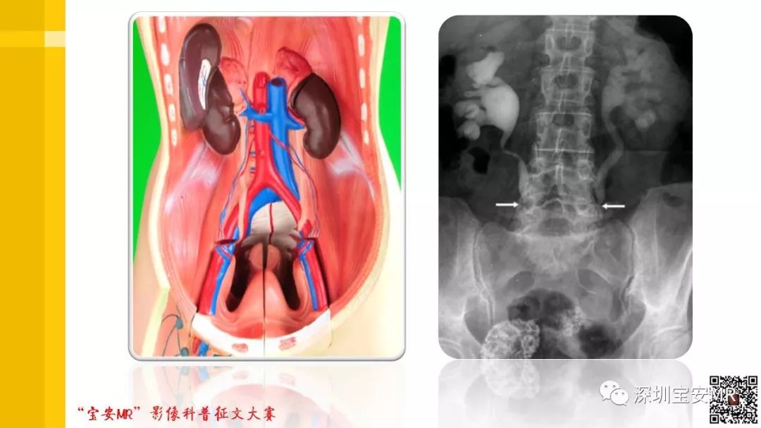 【PPT】腹膜后纤维化的影像诊断
