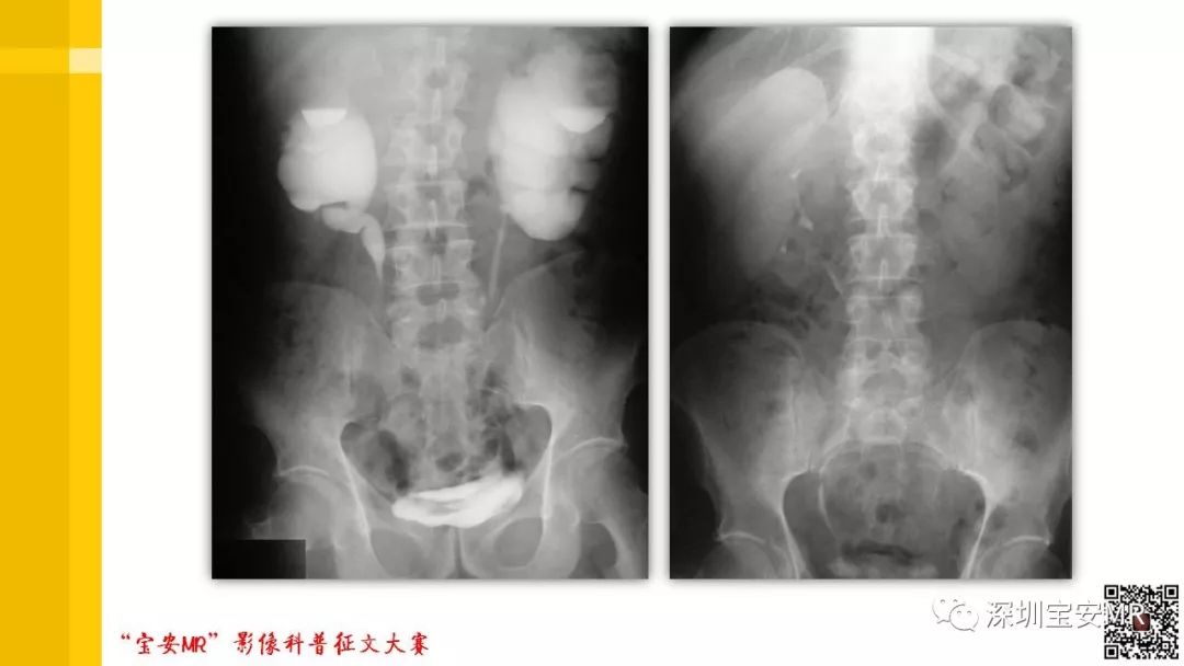 【PPT】腹膜后纤维化的影像诊断