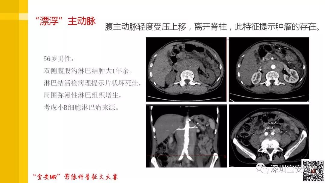 【PPT】腹膜后纤维化的影像诊断
