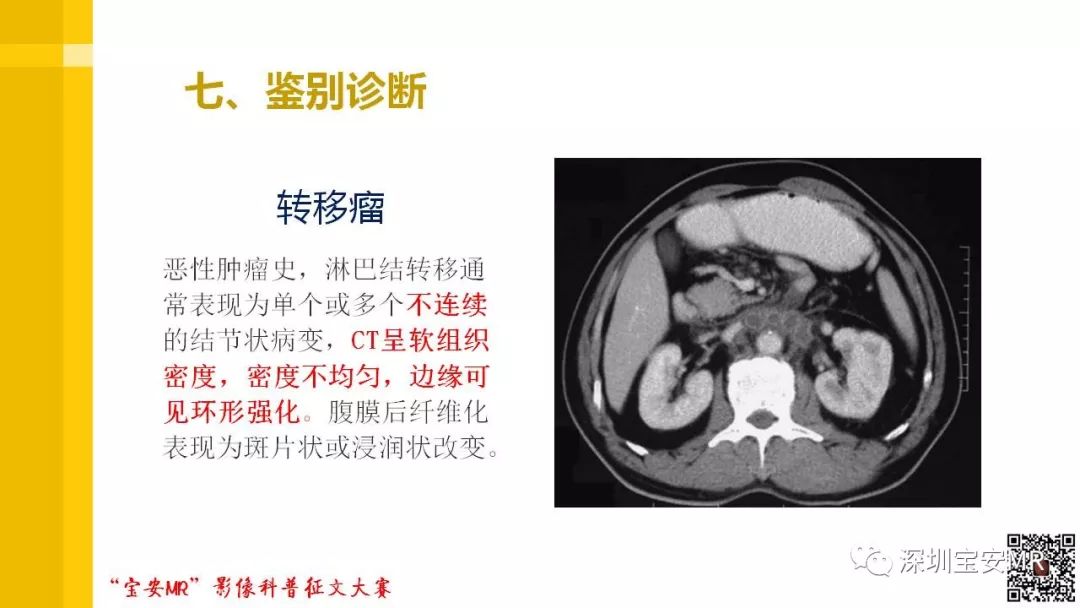【PPT】腹膜后纤维化的影像诊断