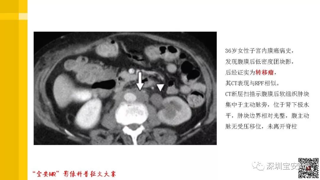 【PPT】腹膜后纤维化的影像诊断