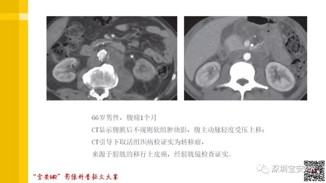 【PPT】腹膜后纤维化的影像诊断