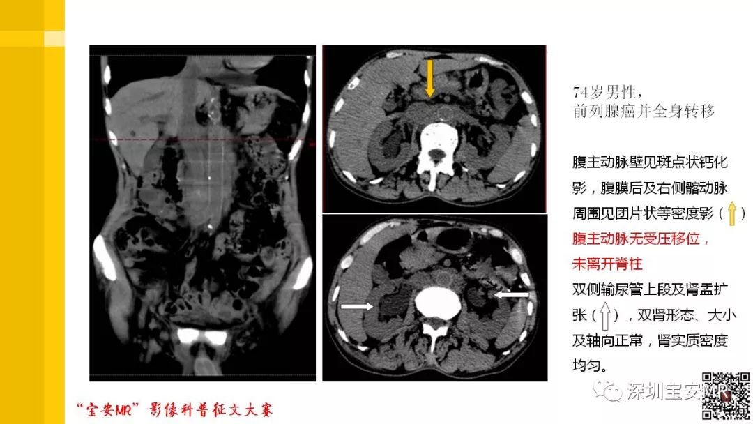 【PPT】腹膜后纤维化的影像诊断