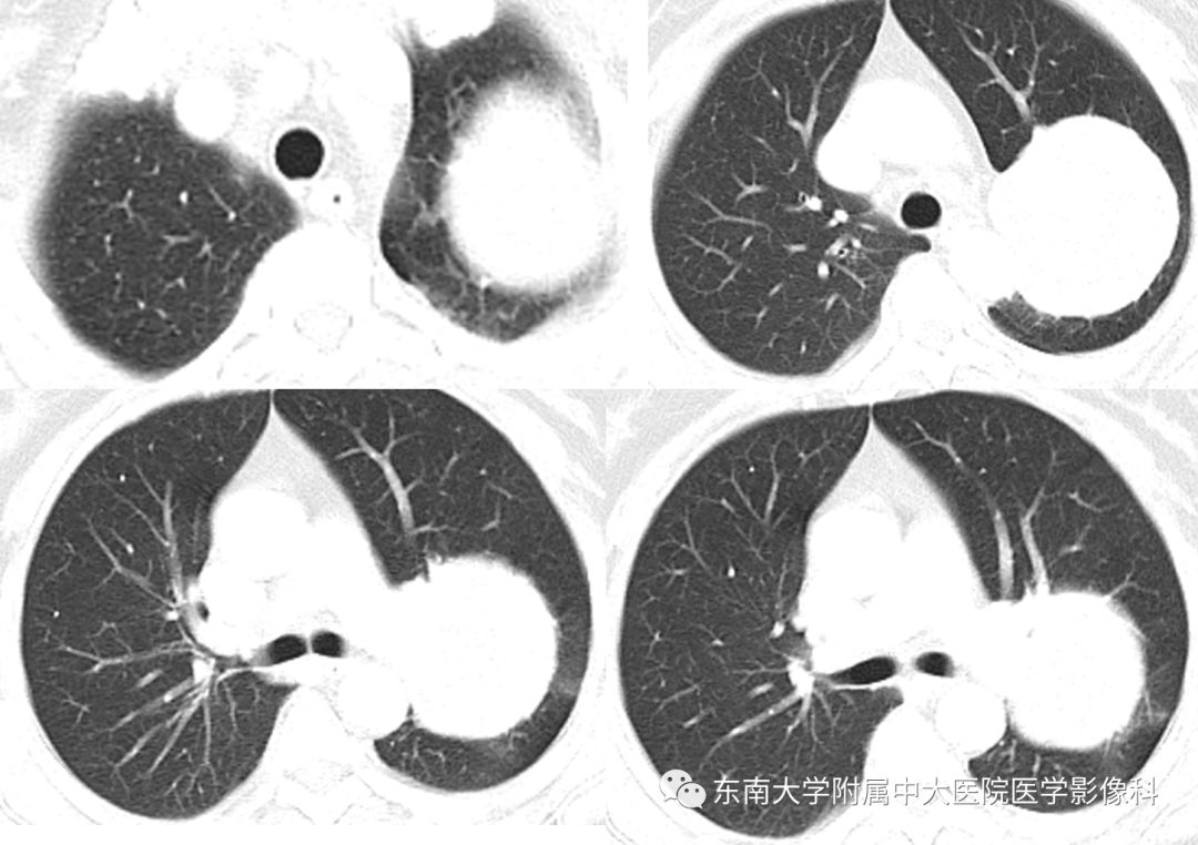 【病例】肺硬化性肺泡细胞瘤/硬化性血管瘤1例CT影像