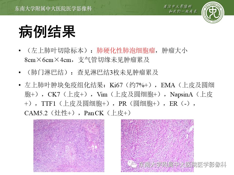 【病例】肺硬化性肺泡细胞瘤/硬化性血管瘤1例CT影像