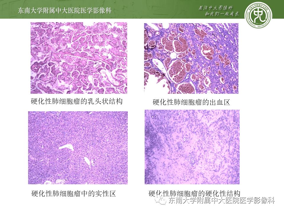 【病例】肺硬化性肺泡细胞瘤/硬化性血管瘤1例CT影像