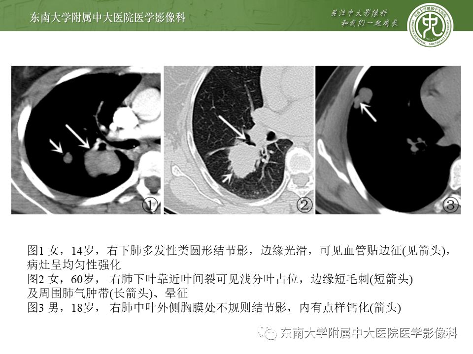 【病例】肺硬化性肺泡细胞瘤/硬化性血管瘤1例CT影像