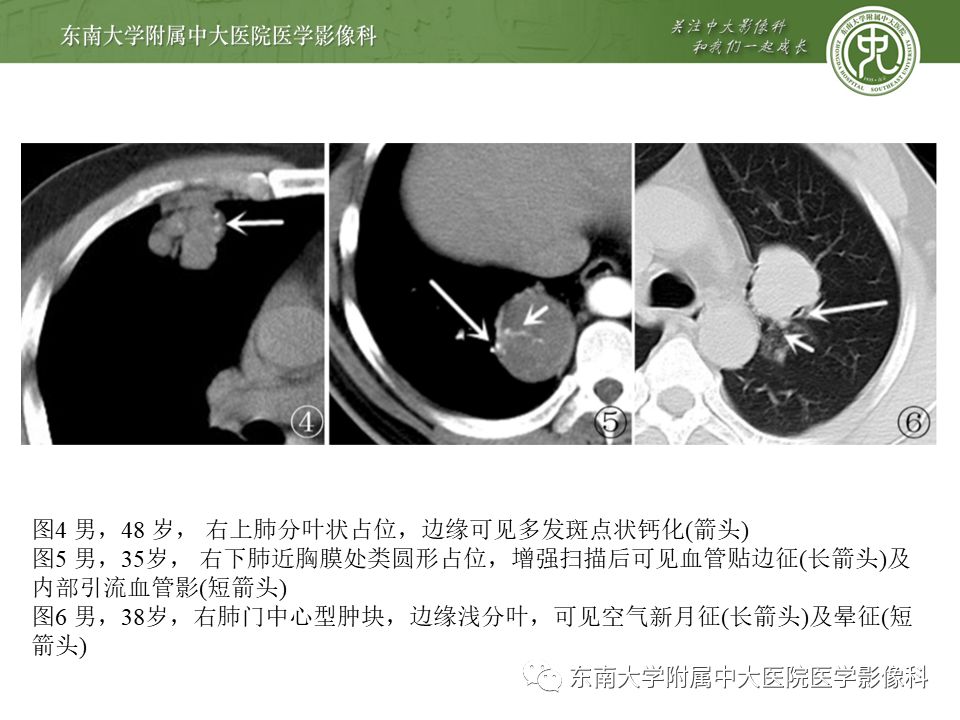 【病例】肺硬化性肺泡细胞瘤/硬化性血管瘤1例CT影像
