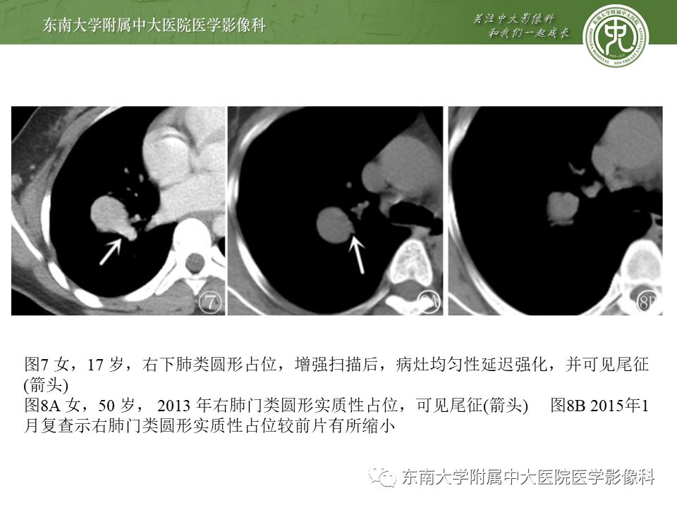 【病例】肺硬化性肺泡细胞瘤/硬化性血管瘤1例CT影像