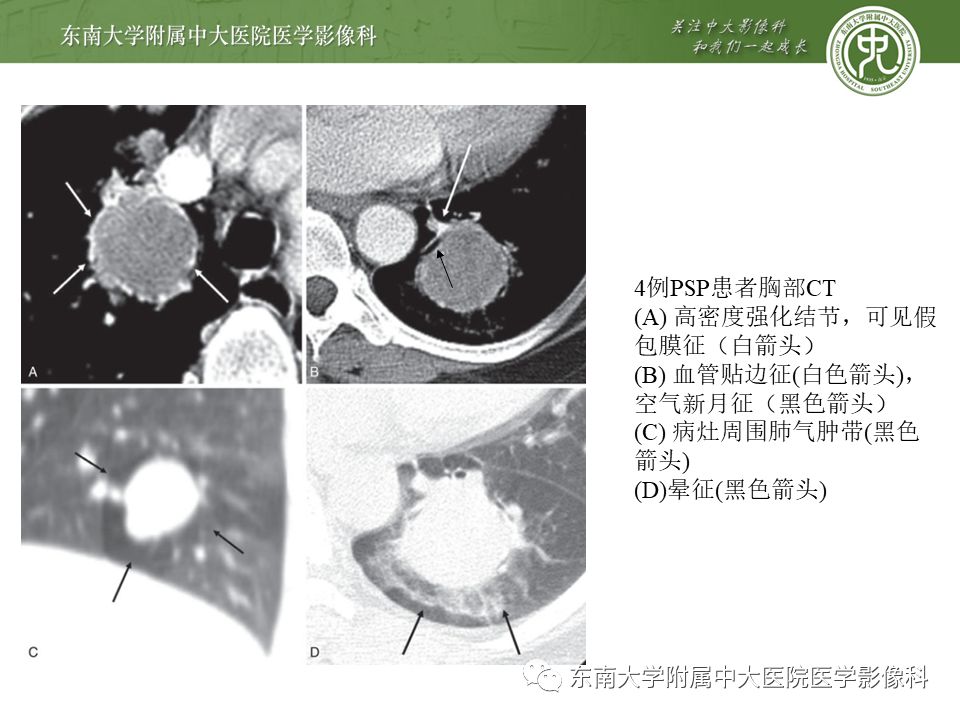 【病例】肺硬化性肺泡细胞瘤/硬化性血管瘤1例CT影像