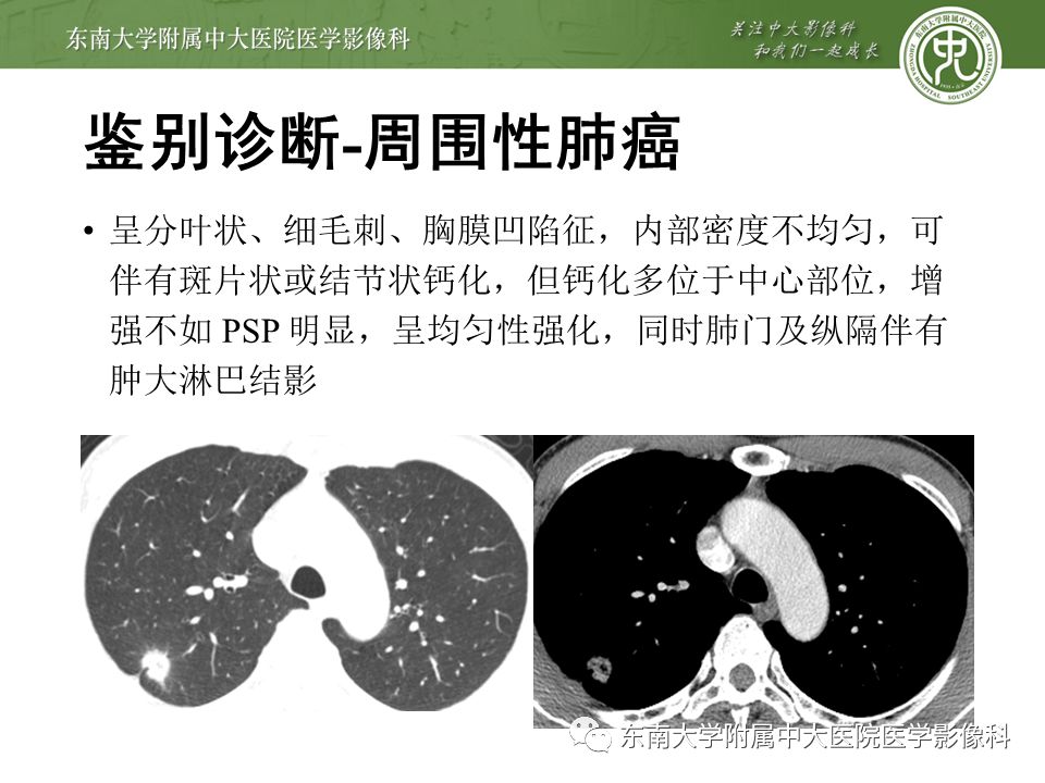 【病例】肺硬化性肺泡细胞瘤/硬化性血管瘤1例CT影像