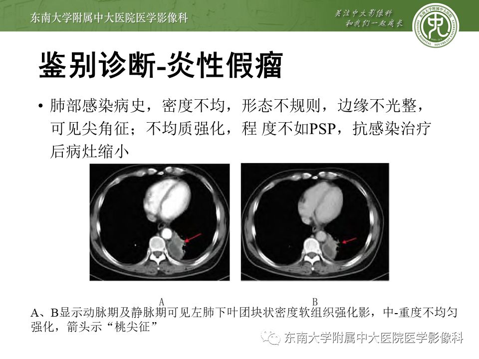 【病例】肺硬化性肺泡细胞瘤/硬化性血管瘤1例CT影像