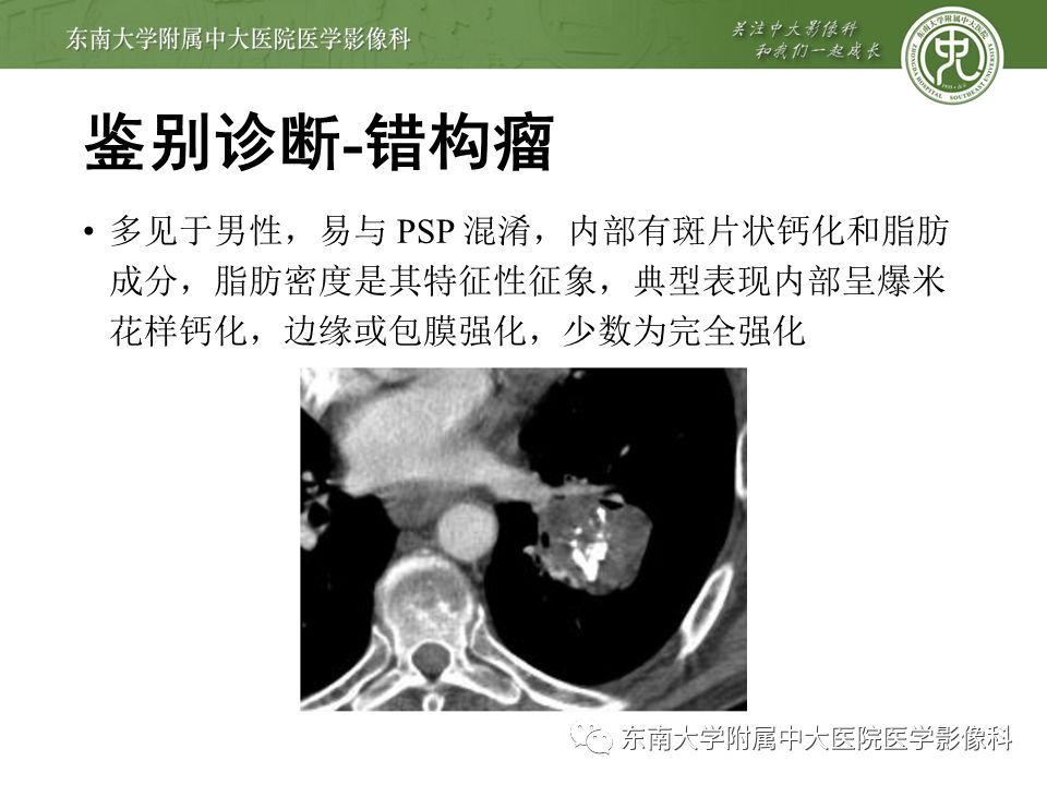 【病例】肺硬化性肺泡细胞瘤/硬化性血管瘤1例CT影像