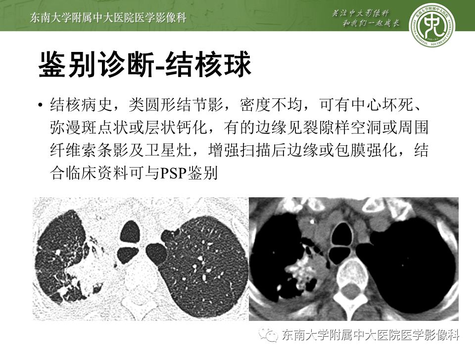 【病例】肺硬化性肺泡细胞瘤/硬化性血管瘤1例CT影像