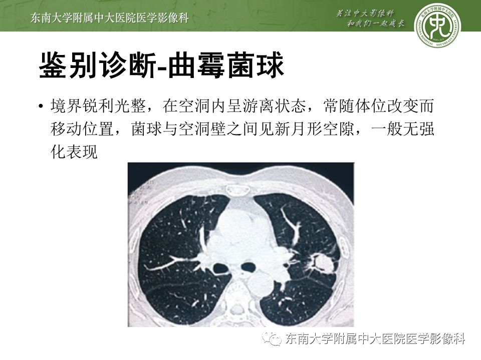 【病例】肺硬化性肺泡细胞瘤/硬化性血管瘤1例CT影像