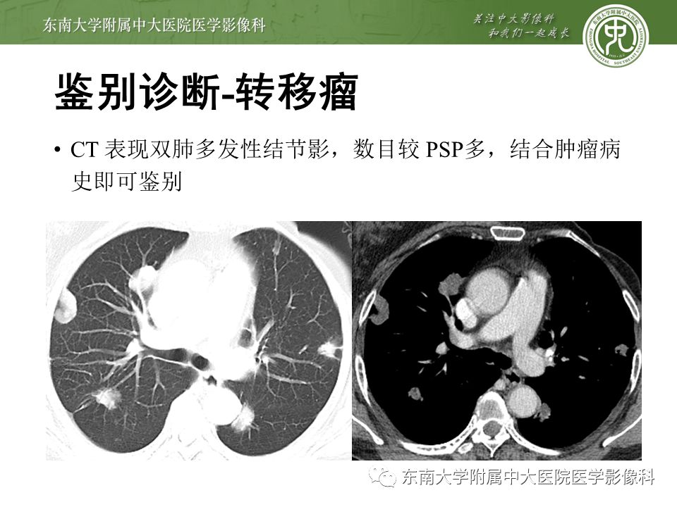 【病例】肺硬化性肺泡细胞瘤/硬化性血管瘤1例CT影像