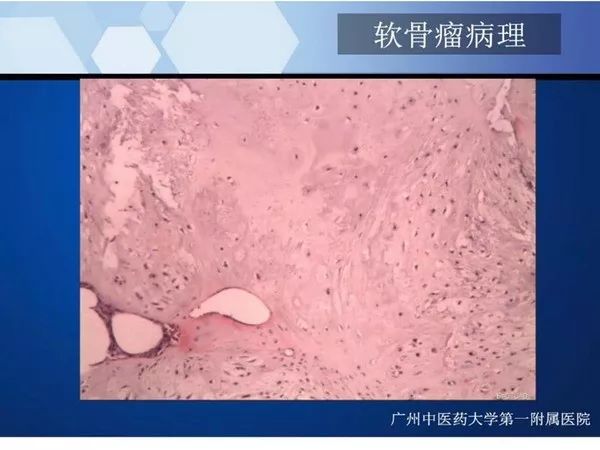 【PPT】不同部位软骨瘤影像诊断