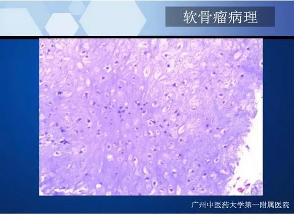 【PPT】不同部位软骨瘤影像诊断