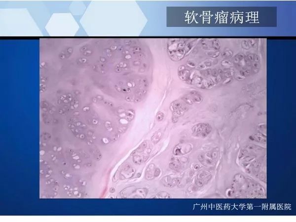 【PPT】不同部位软骨瘤影像诊断
