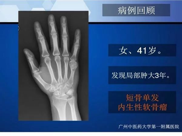 【PPT】不同部位软骨瘤影像诊断