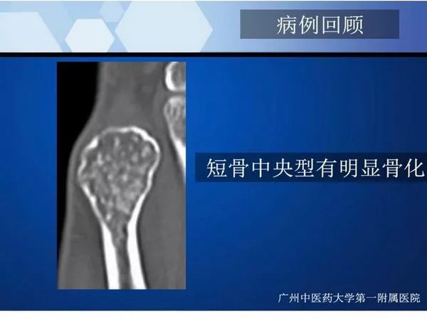 【PPT】不同部位软骨瘤影像诊断