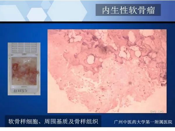 【PPT】不同部位软骨瘤影像诊断