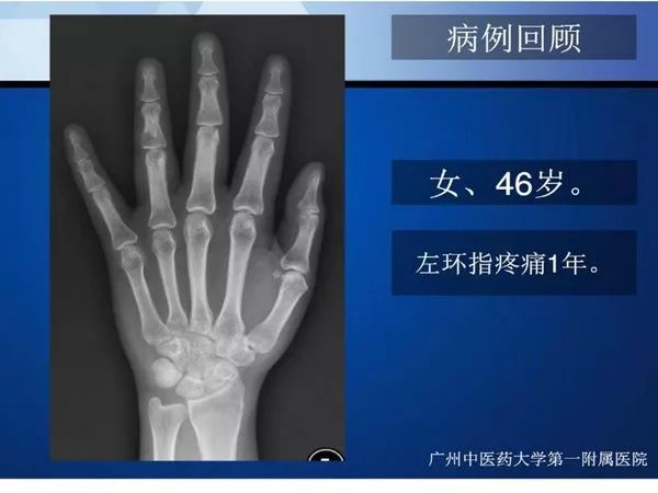 【PPT】不同部位软骨瘤影像诊断