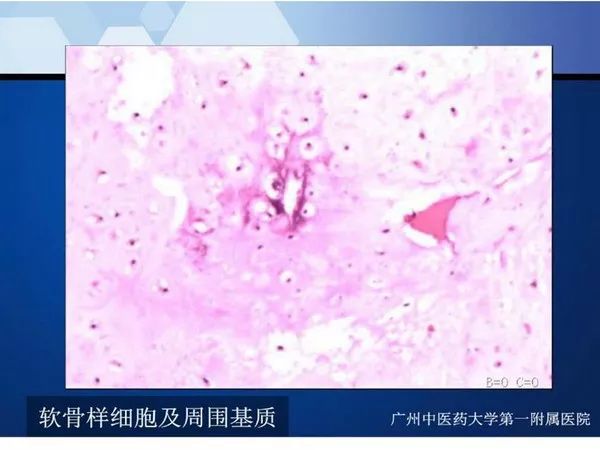 【PPT】不同部位软骨瘤影像诊断