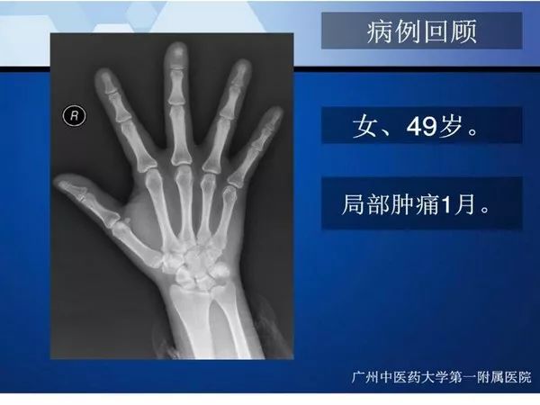 【PPT】不同部位软骨瘤影像诊断