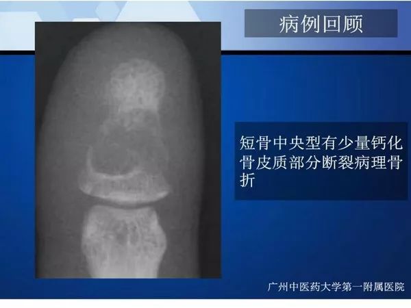 【PPT】不同部位软骨瘤影像诊断