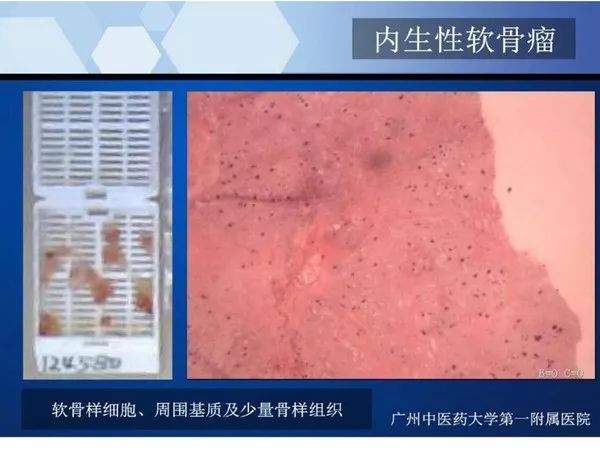 【PPT】不同部位软骨瘤影像诊断