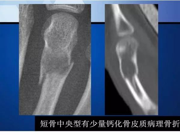 【PPT】不同部位软骨瘤影像诊断