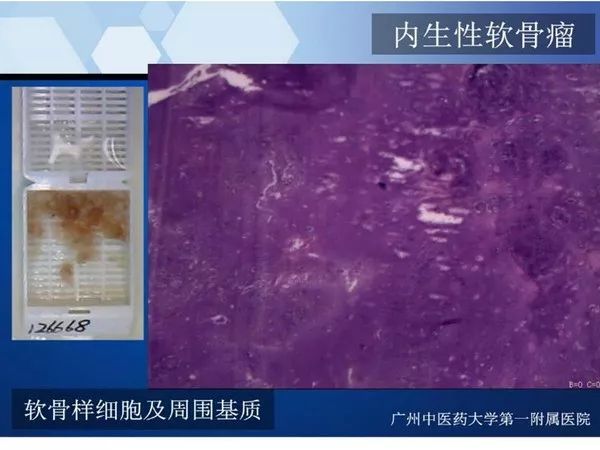 【PPT】不同部位软骨瘤影像诊断
