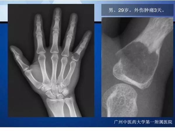 【PPT】不同部位软骨瘤影像诊断