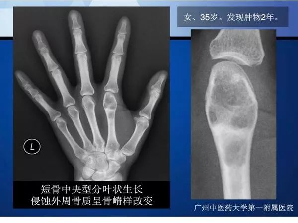 【PPT】不同部位软骨瘤影像诊断