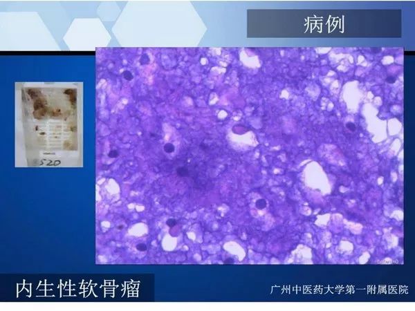 【PPT】不同部位软骨瘤影像诊断