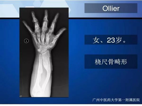 【PPT】不同部位软骨瘤影像诊断