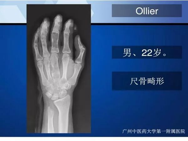 【PPT】不同部位软骨瘤影像诊断