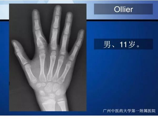 【PPT】不同部位软骨瘤影像诊断