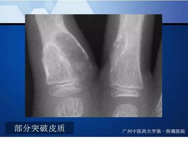 【PPT】不同部位软骨瘤影像诊断