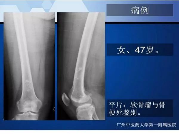 【PPT】不同部位软骨瘤影像诊断
