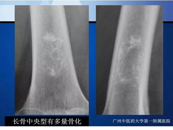 【PPT】不同部位软骨瘤影像诊断