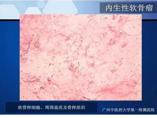 【PPT】不同部位软骨瘤影像诊断