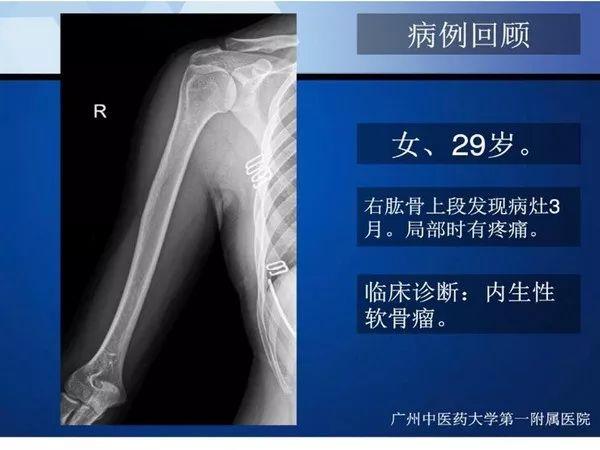 【PPT】不同部位软骨瘤影像诊断