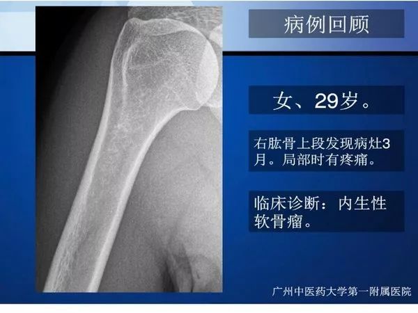【PPT】不同部位软骨瘤影像诊断