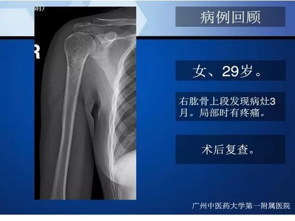 【PPT】不同部位软骨瘤影像诊断