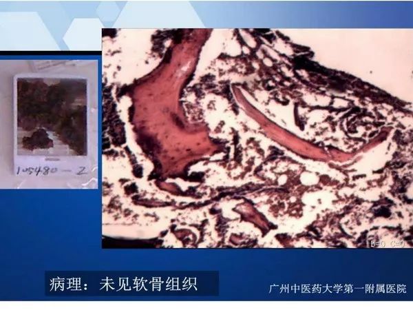 【PPT】不同部位软骨瘤影像诊断