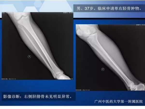 【PPT】不同部位软骨瘤影像诊断