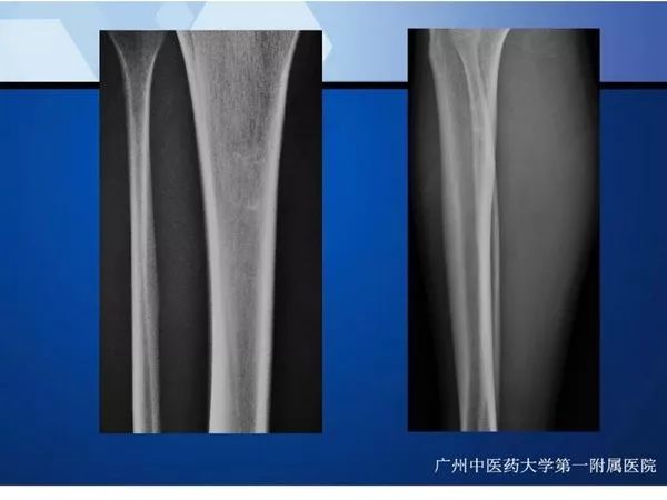 【PPT】不同部位软骨瘤影像诊断